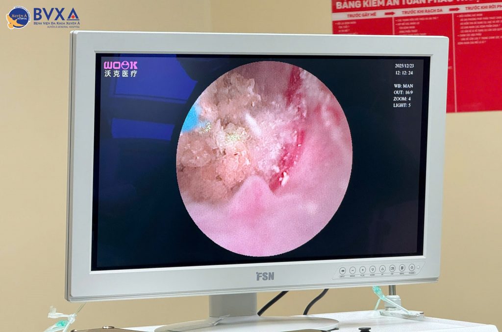  Hình ảnh quán trình tán sỏi