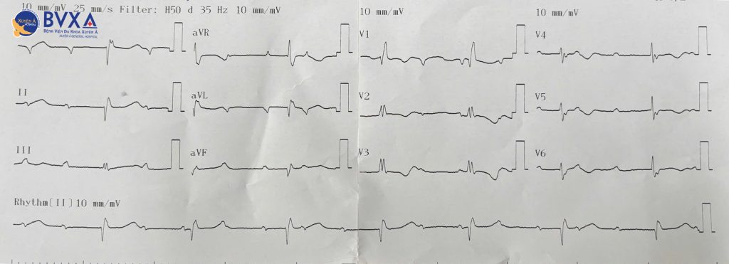 Hình ảnh điện tim của bệnh nhân rối loạn nhịp tim