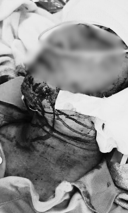 Hình ảnh vết thương do bị thang máy kẹp cổ khi mới nhập viện