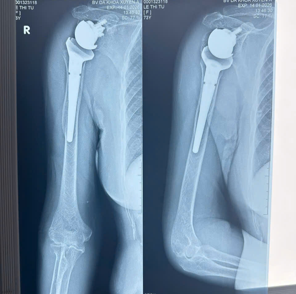 Hình ảnh X quang trước vào sau khi thực hiện phẫu thuật thay khớp vai đảo nghịch
