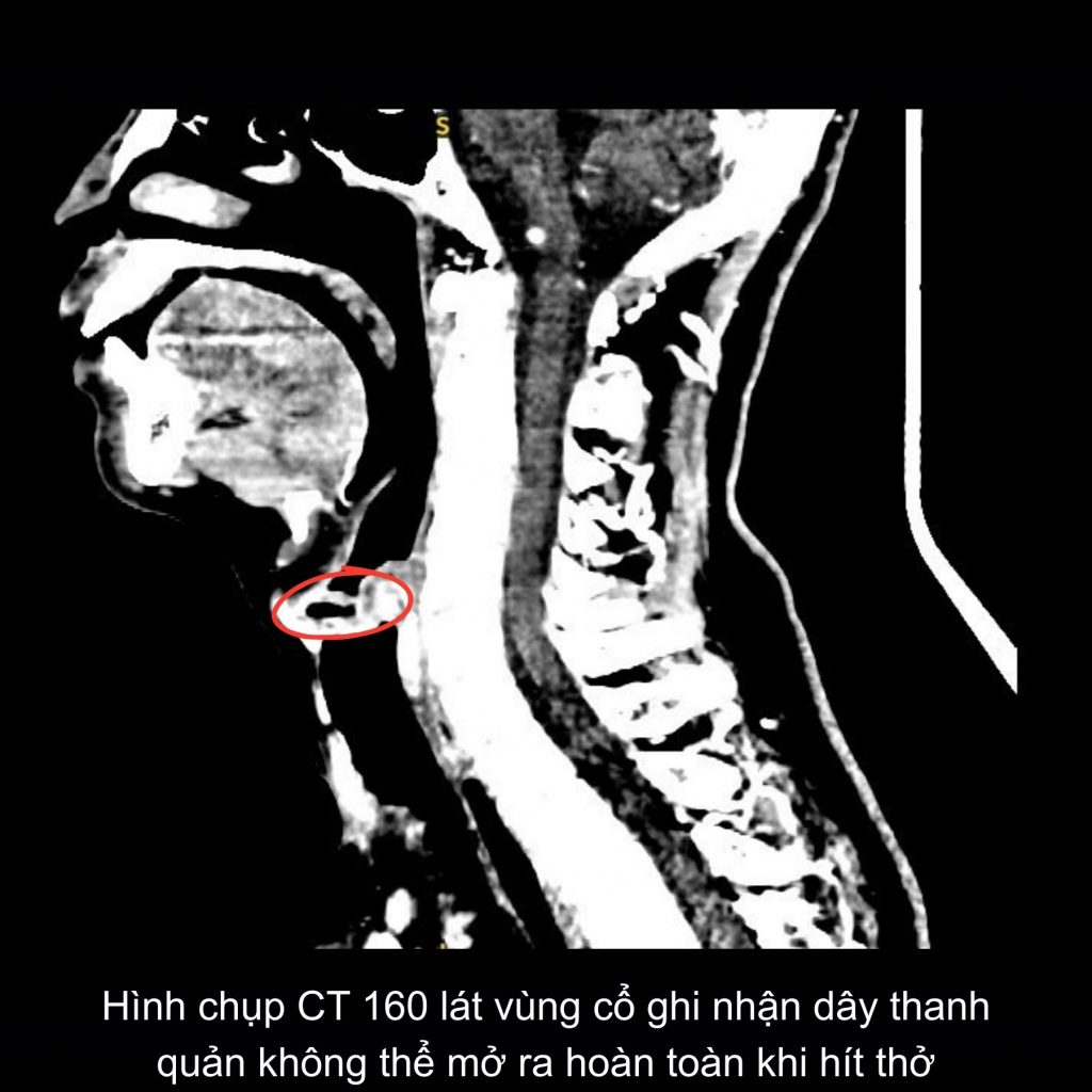 Hình ảnh CT của bệnh nhân