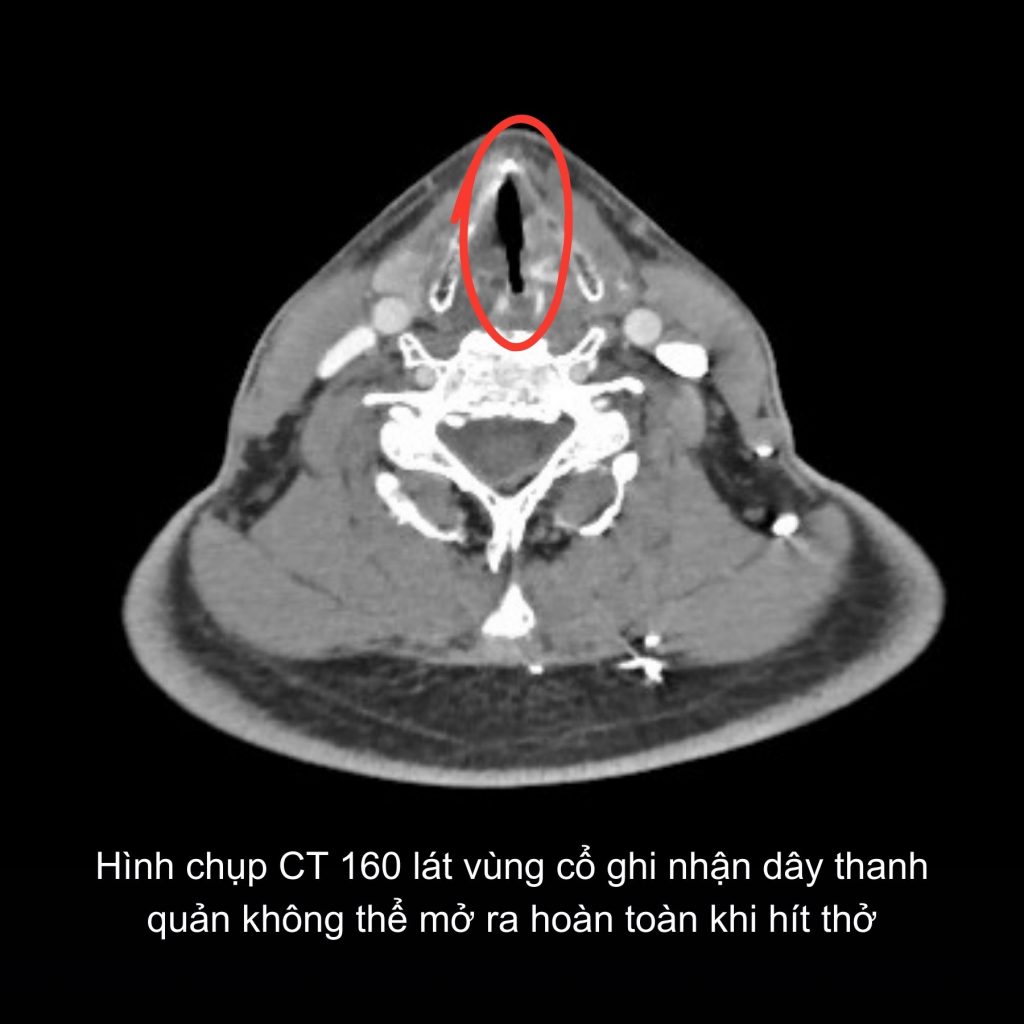 Hình ảnh CT của bệnh nhân