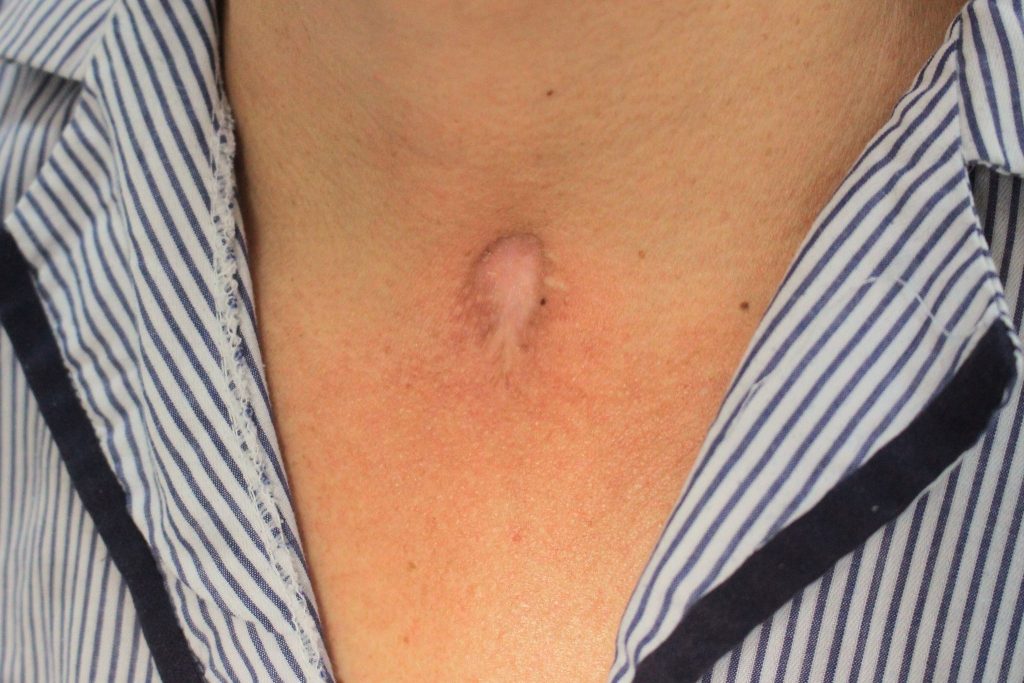 Hình ảnh vết mổ cắt bỏ 1/2 thanh quản 