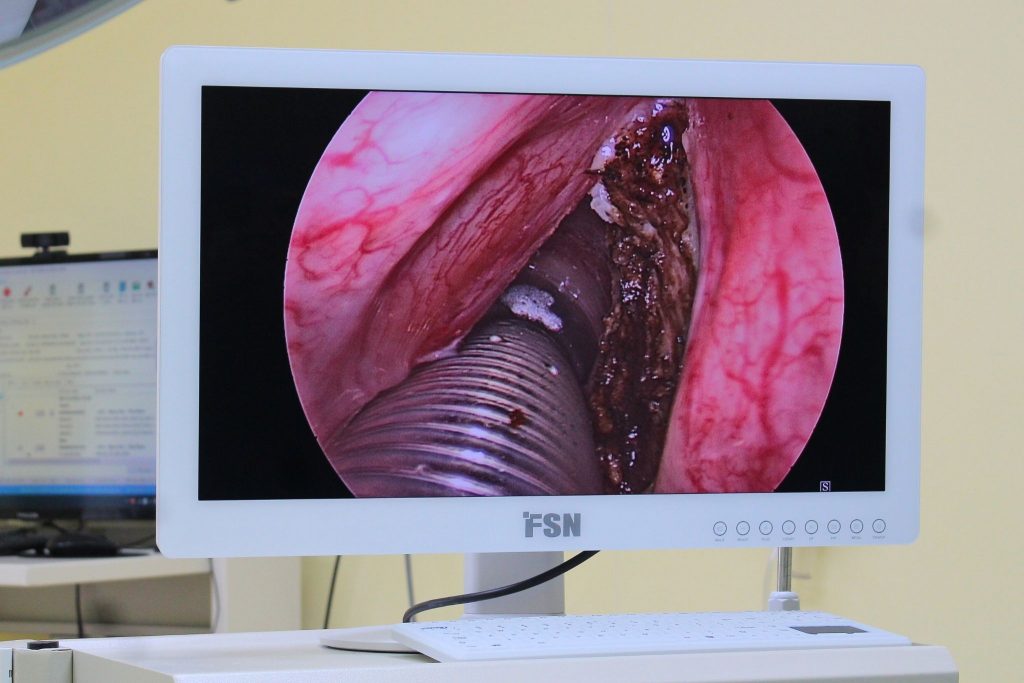 Quá trình cắt bỏ 1/2 thanh quản giúp người đàn ông thoát khỏi khó thở kéo dài