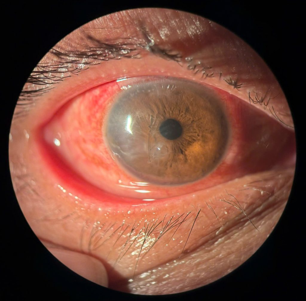 Mắt bệnh nhân sau phẫu thuật