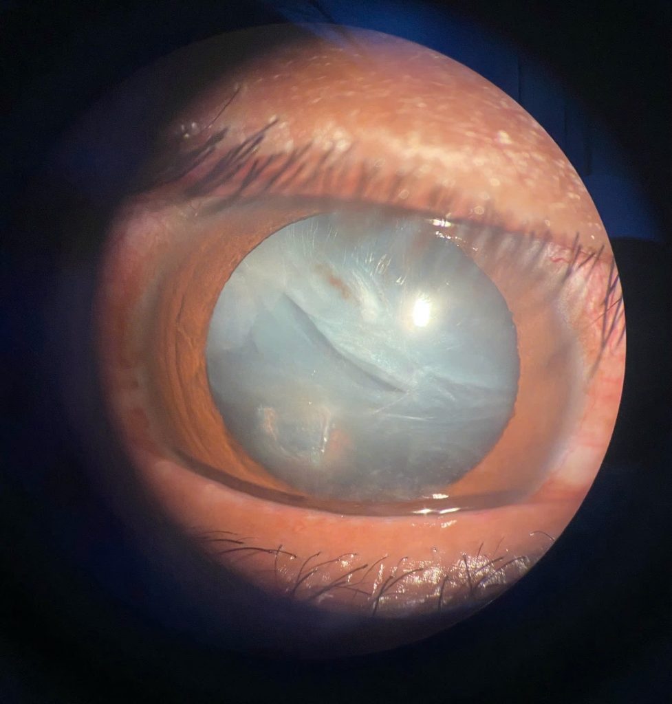 Mắt bị chấn thương xuyên nhãn cầu rách giác mạc