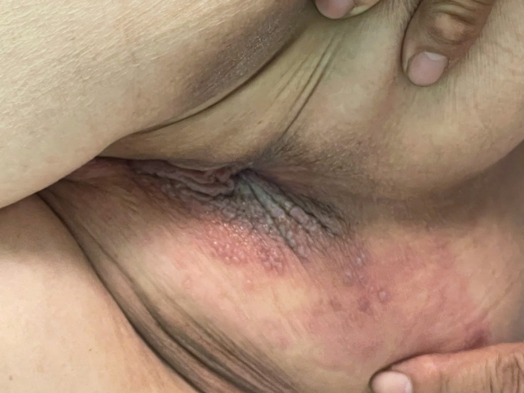 Tổn thương da của bệnh nhân trước khi điều trị