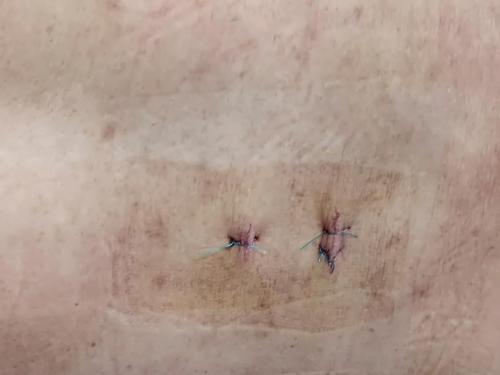 Vết mổ nội soi cột sống nhỏ ít đau mau hồi phục