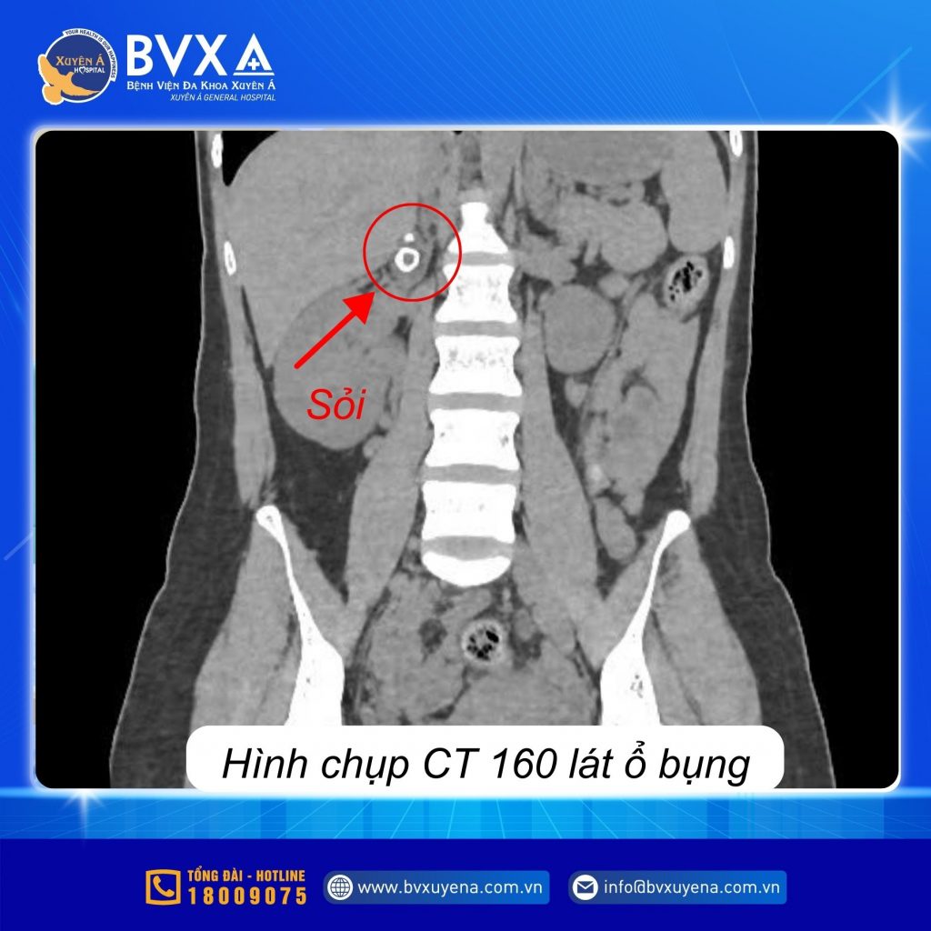 Hình ảnh CT của bệnh nhân bị viêm đường mật, viêm túi mật