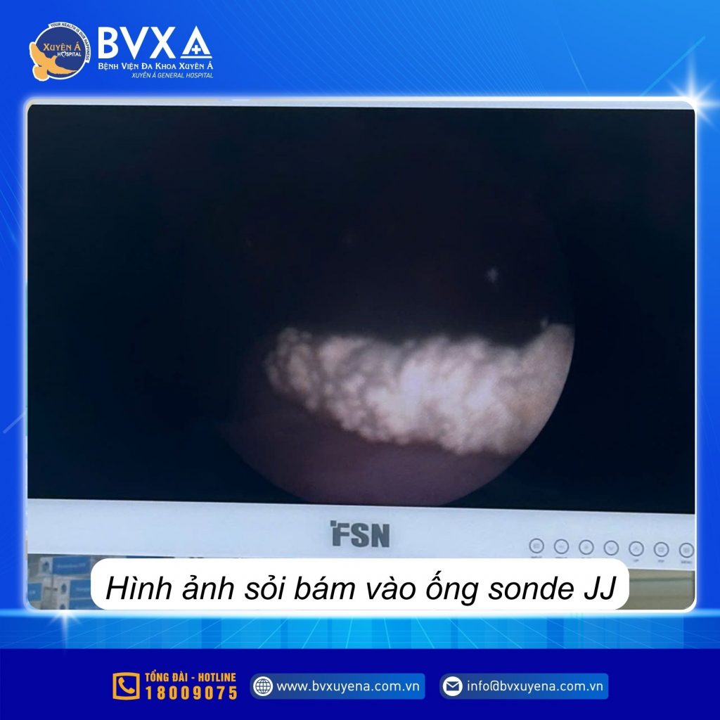 Hình ảnh sỏi bám vào ống Sonde JJ