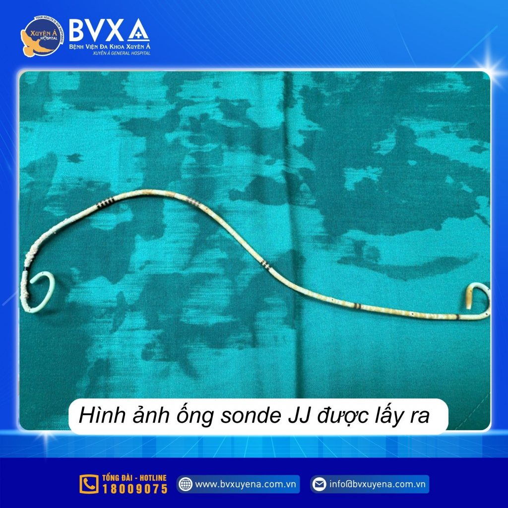 Hình ảnh ống Sonde JJ đã được lấy ra
