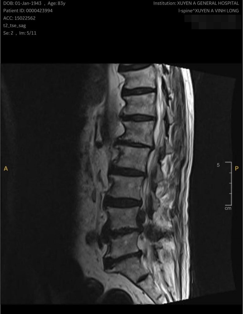Hình ảnh cận lân sàng của bệnh nhân phải phẫu thuật cột sống