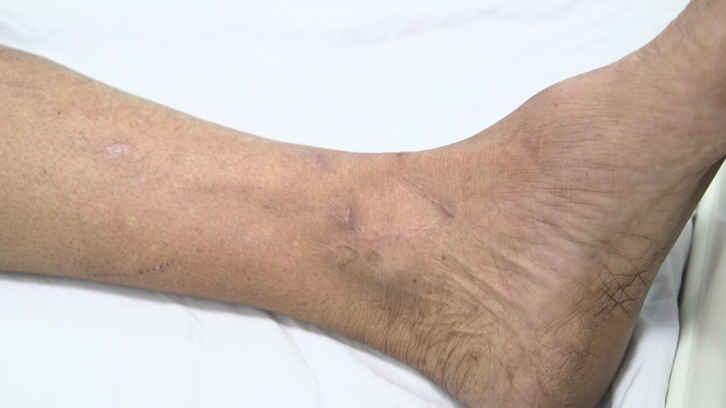 Bệnh nhân bị uốn ván bị nhiều vết thương ở chân