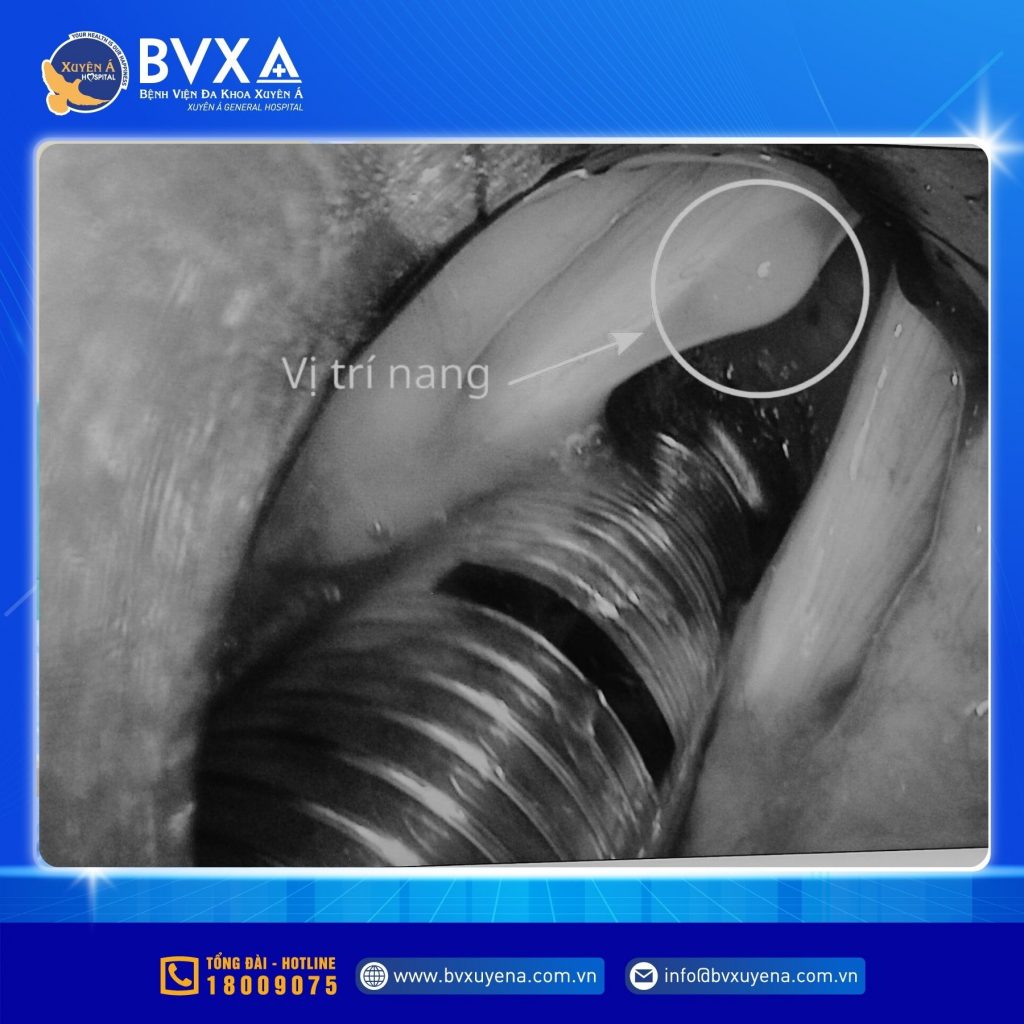 Hình ảnh cho thấy vị trí nang dây thanh