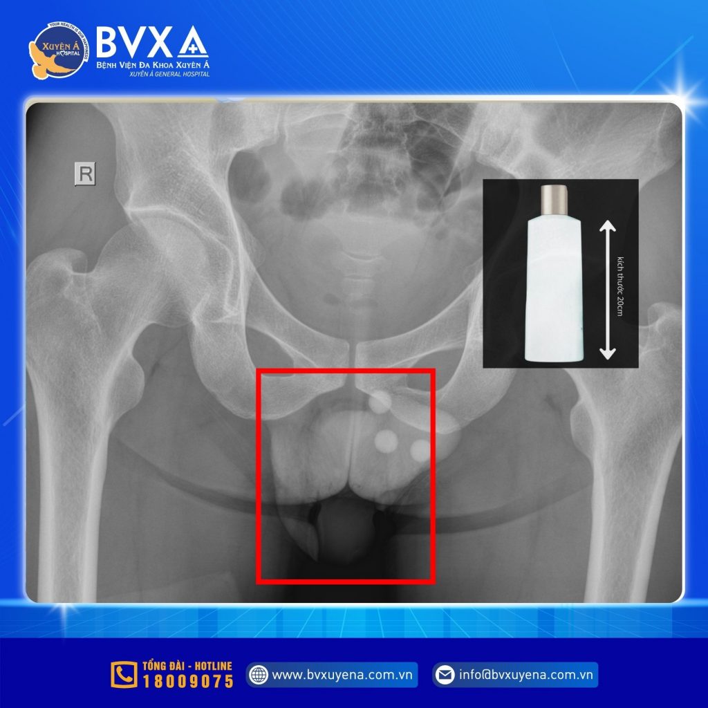Hình ảnh X-Quang