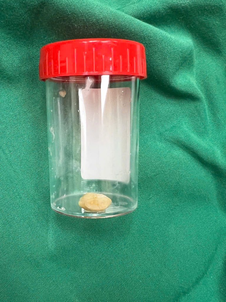 Dị vật hạt đậu phộng sau khi lấy ra