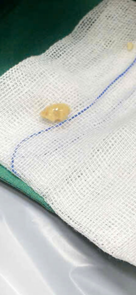 Hạt đậu phộng sau khi lấy ra