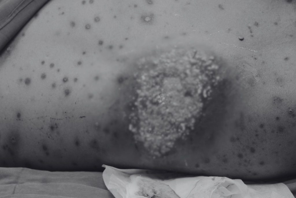 Hình ảnh mụn nhọt hoà thành u mủ khổng lồ