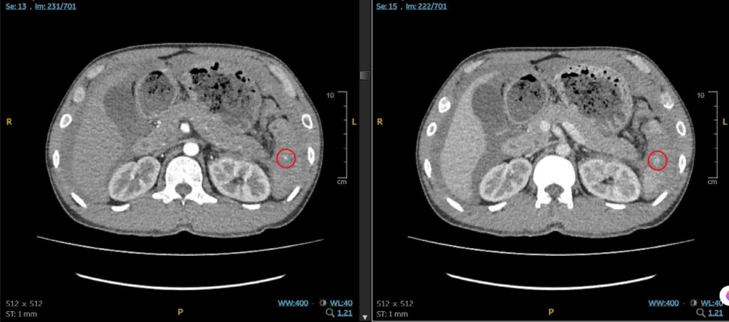 Hình ảnh CT vị trí tổn thương, cho thấy vỡ lách