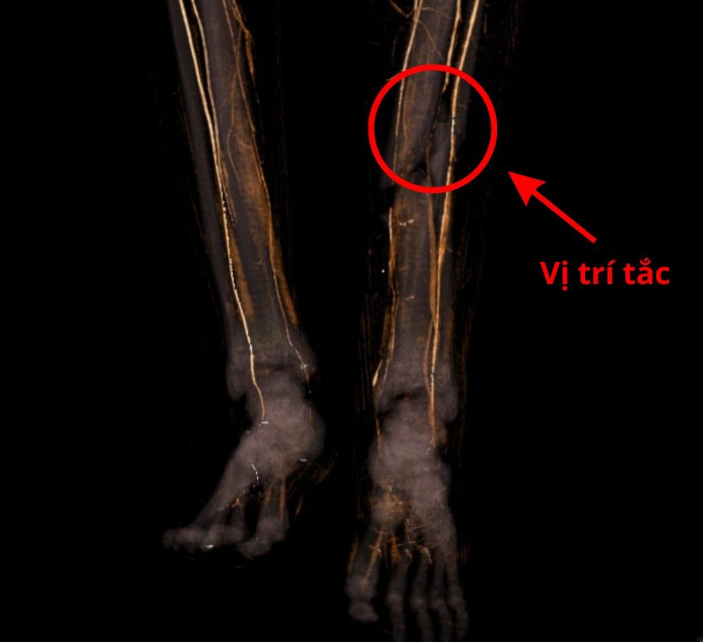 Hình ảnh CT mạch máu