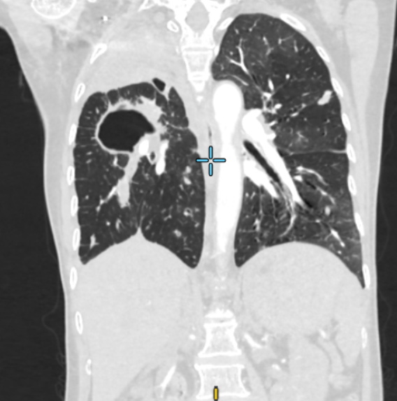 Hình ảnh CT tổn thương phổi do ho ra máu