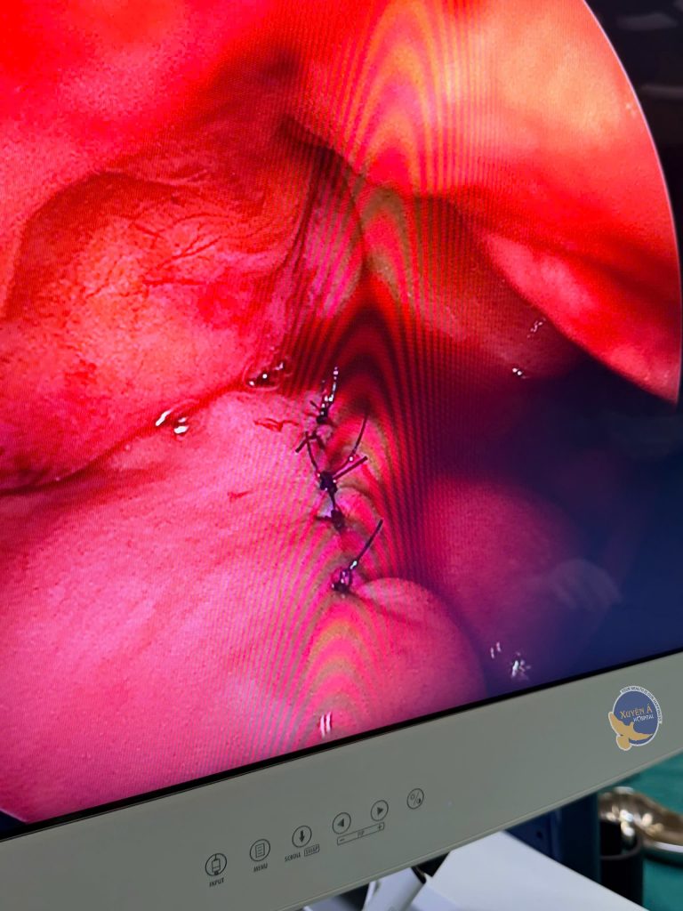 Hình ảnh bàng quang sau phẫu thuật