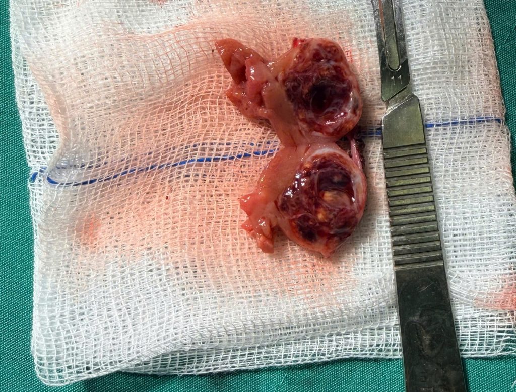 Hình ảnh bướu thận được lấy ra