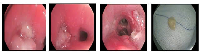 Hình ảnh nội soi dị vật trong phế quản