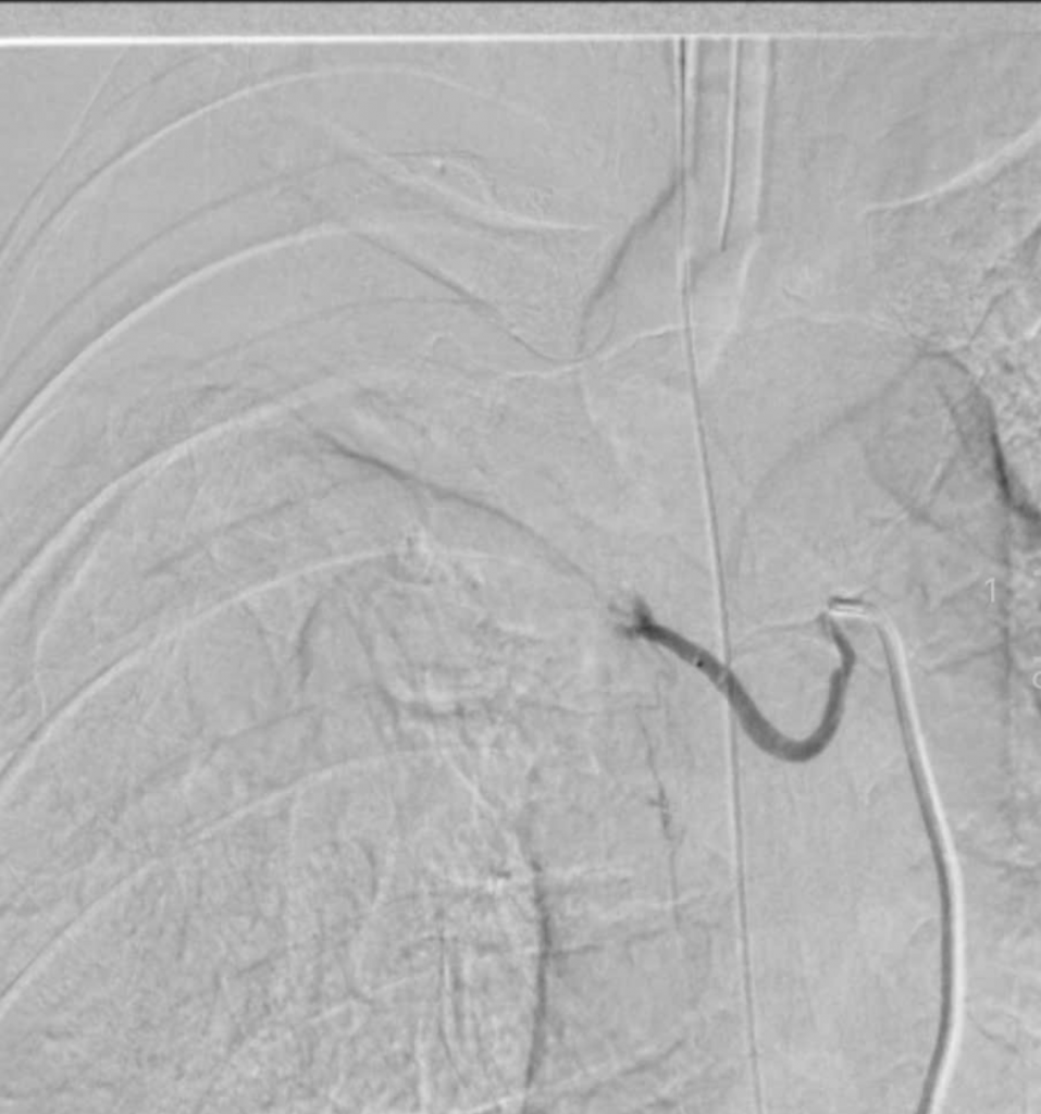 Hình ảnh sau can thiệp