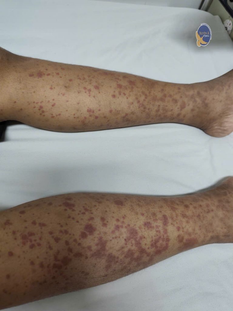 Hình ảnh vết ban lúc mới vô viện