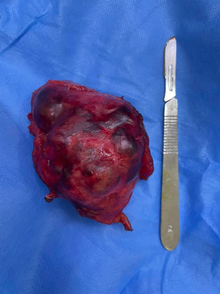 Hình ảnh khối u tụy sau khi được cắt bỏ