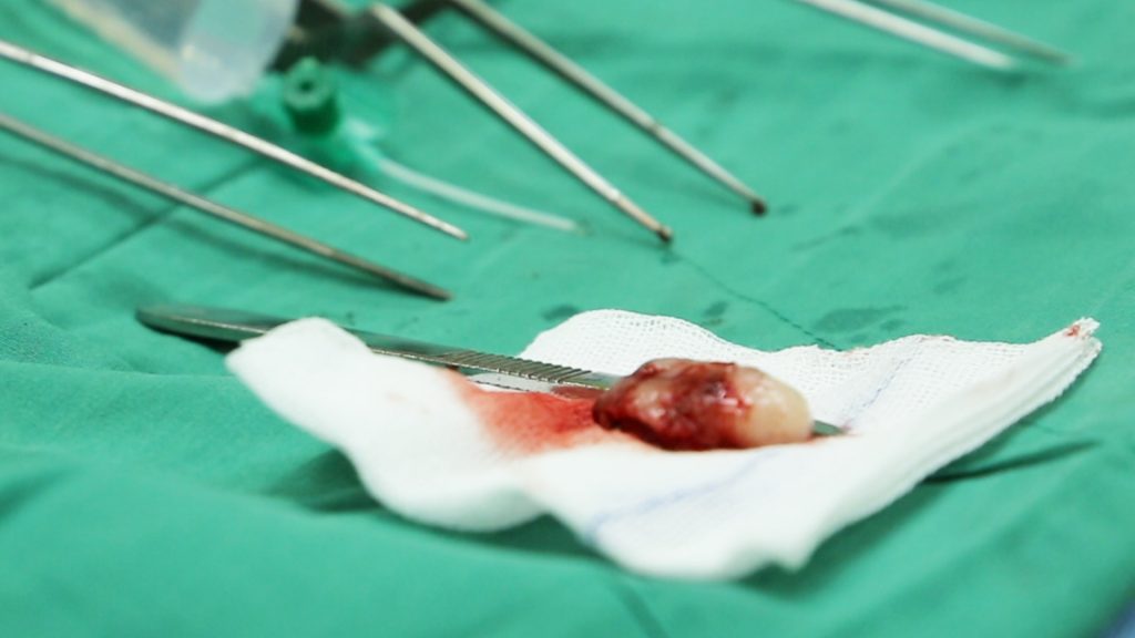 Hình ảnh khối u tuỷ sống 3cm