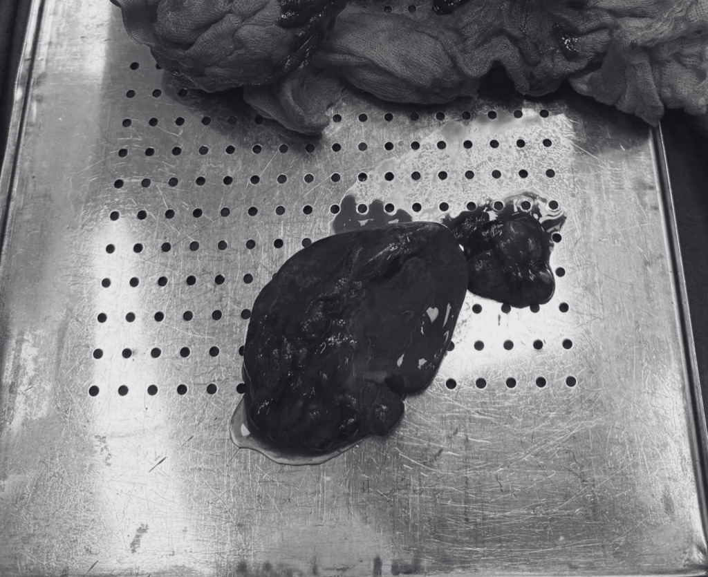 Hình ảnh lá lách sau khi bị cắt bỏ