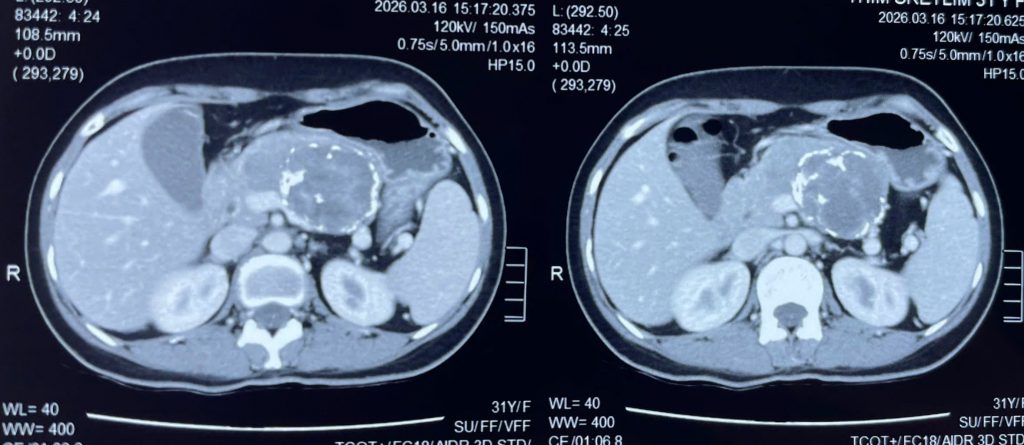 Hình ảnh phim CT khối u tụy