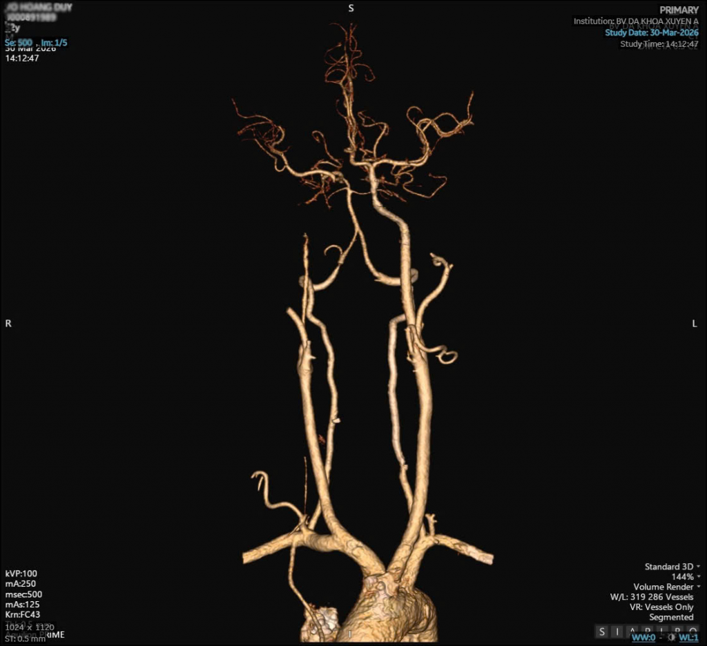 Hình ảnh phim CT bệnh nhân D