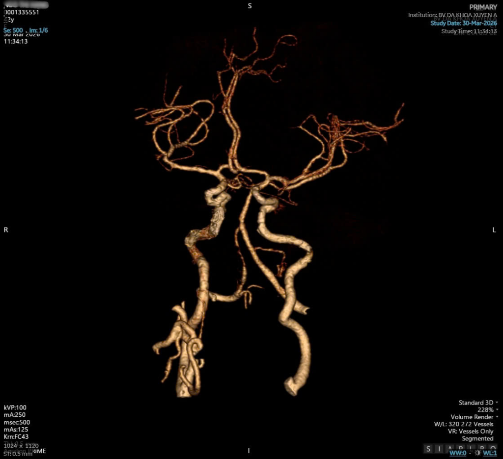 Hình ảnh phim CT bệnh nhân H