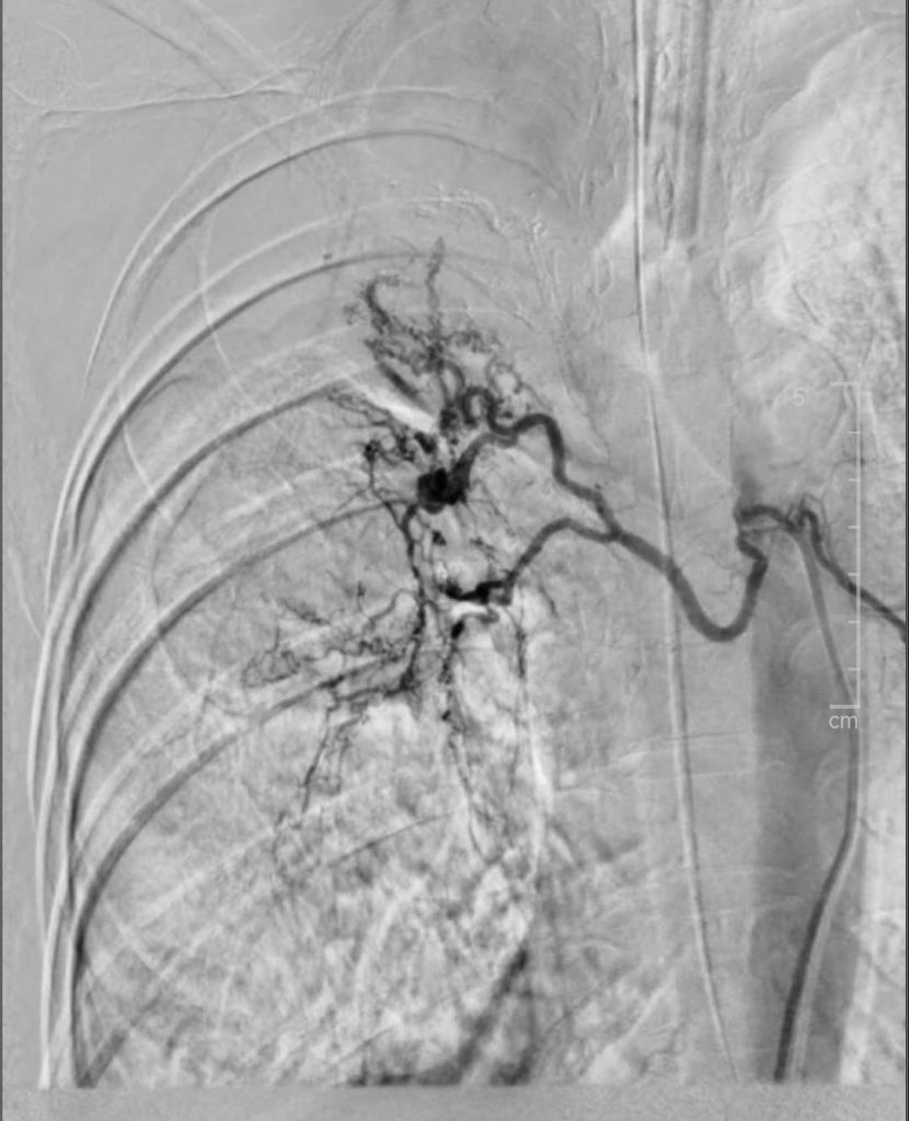 Quá trình can thiệp tắc động mạch phế quản