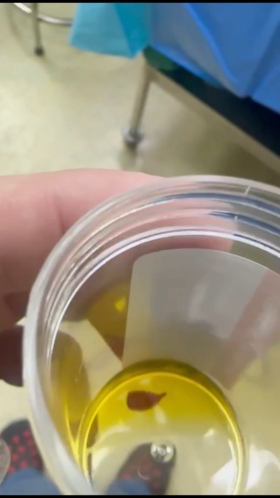 Hình ảnh sán lá gan