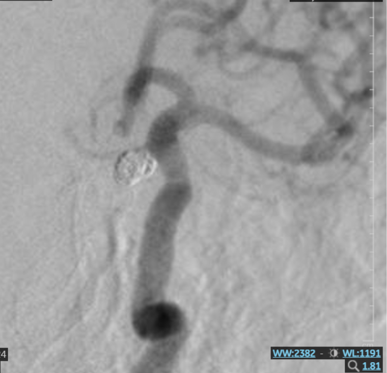 Hình ảnh túi phình mạch máu não sau can thiệp