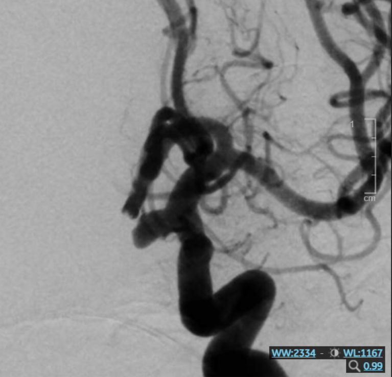 Hình ảnh túi phình mạch máu não trước can thiệp