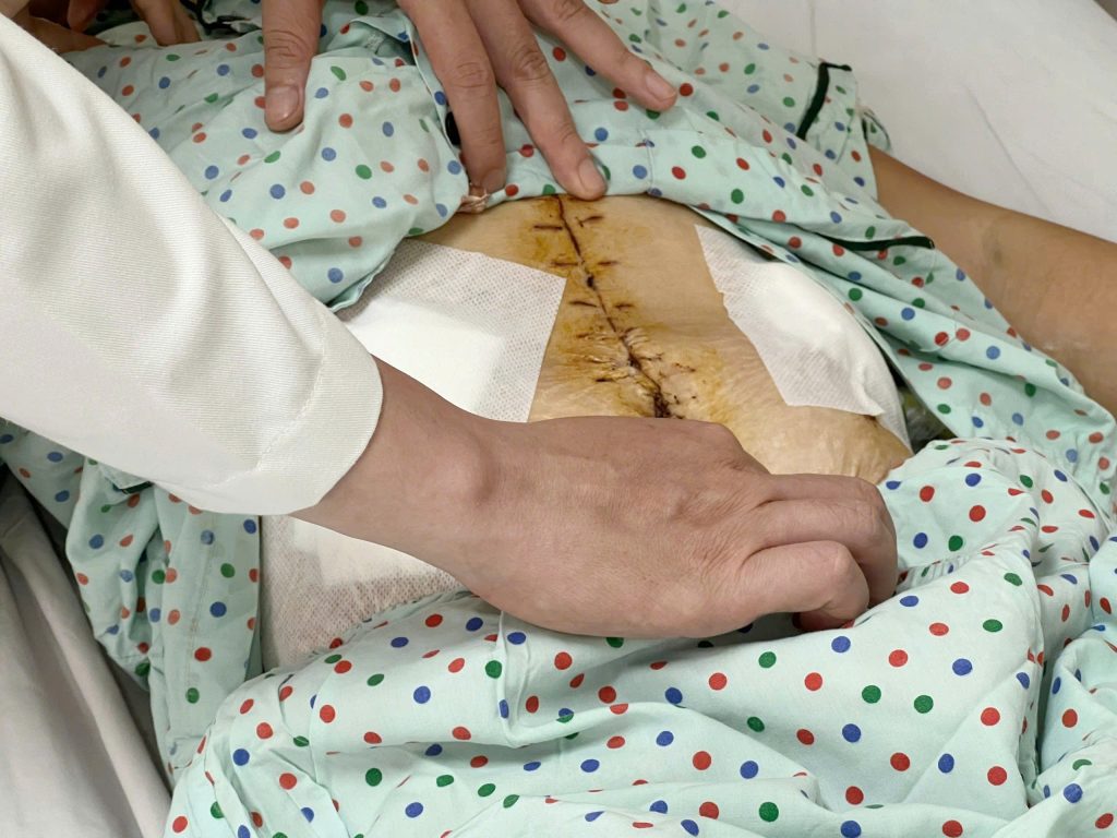 Hình ảnh vết mổ