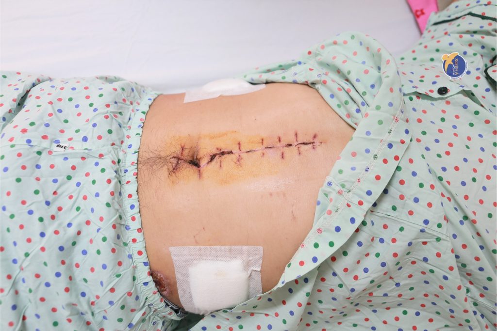 Hình ảnh vết mổ