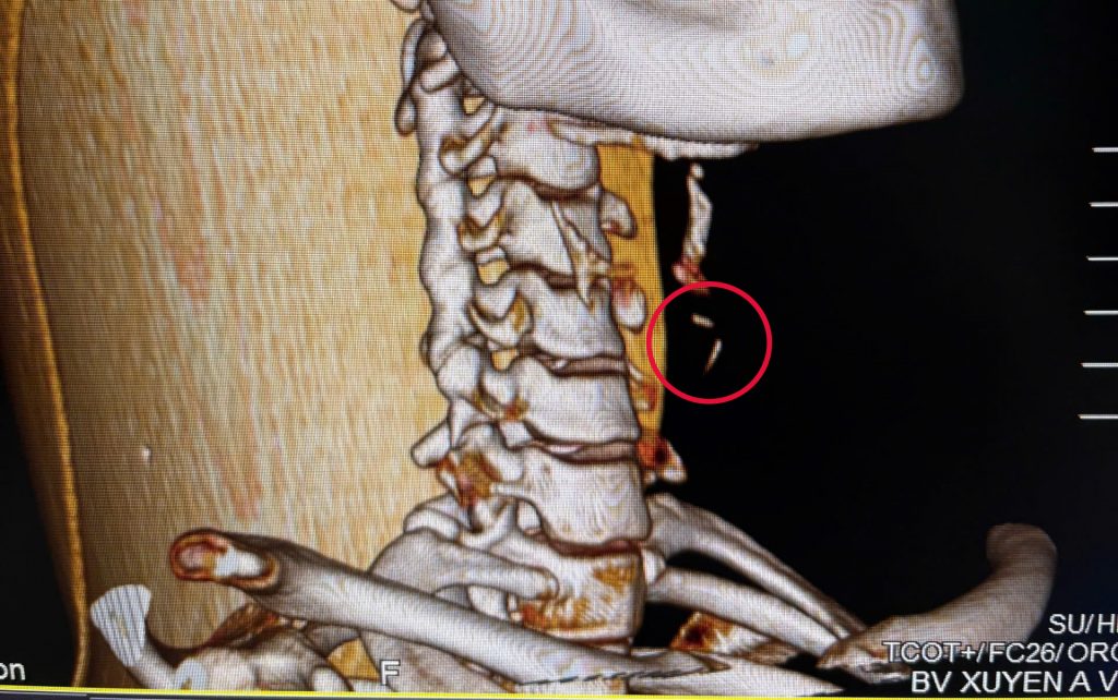 Hình CT scan 3D cổ ngực cản quang cho thấy hình ảnh ổ áp xe cổ trái có chứa dị vật