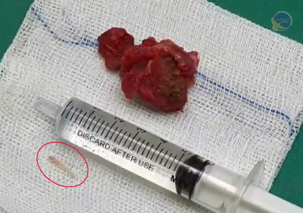Hình ảnh ổ áp xe và dị vật xương cá đã được các bác sĩ lấy ra khỏi vùng cổ