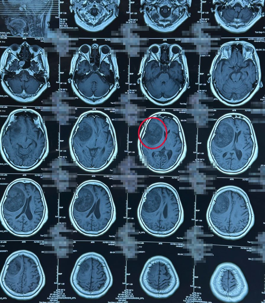 Hình ảnh MRI ghi nhận ghi nhận khối u màng não vùng thái dương phải