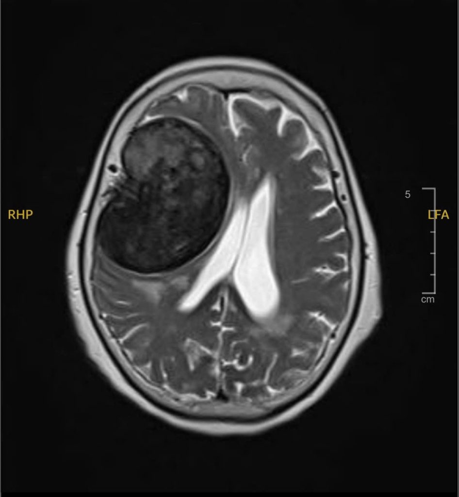 Hình ảnh MRI ghi nhận khối u màng não vùng thái dương phải 