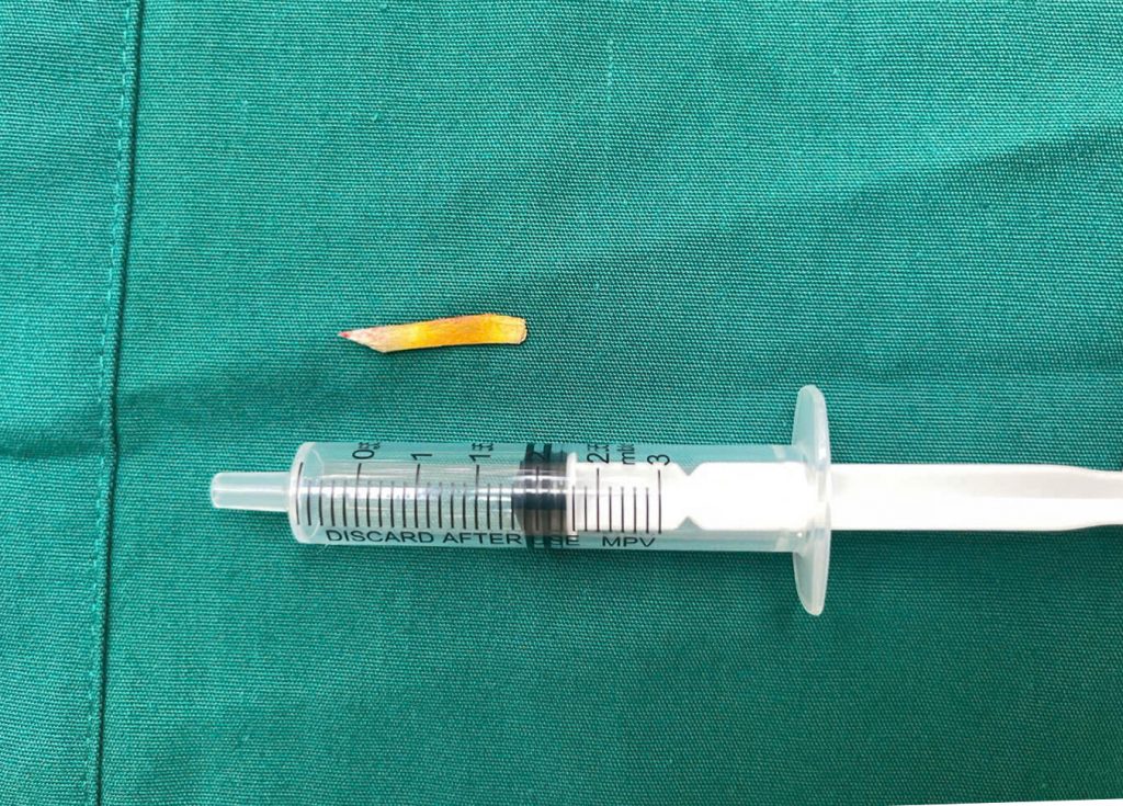 Dị vật sắc nhọn đã được các BS gấp ra ngoài