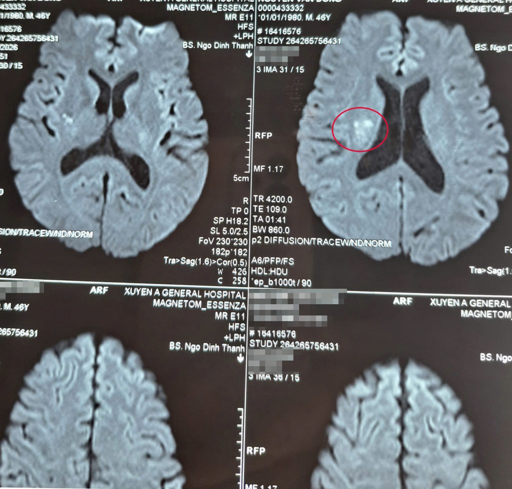 Hình ảnh MRI xác định vị trí tổn thương do đột quỵ nhồi máu não