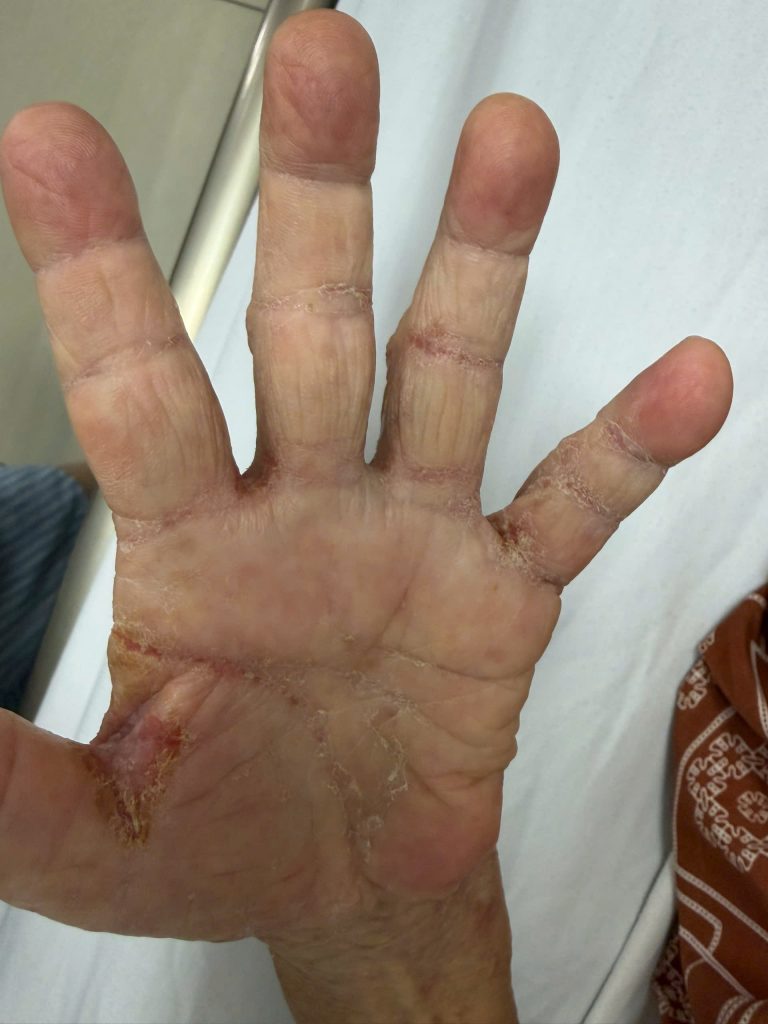 Kẽ ngón tay bệnh nhân xuất hiện dày sừng da, bỏng vảy trước khi điều trị