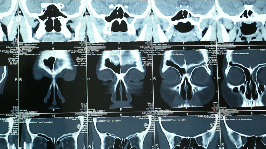 Phim MRI ca bệnh nhân viêm xoang do nấm